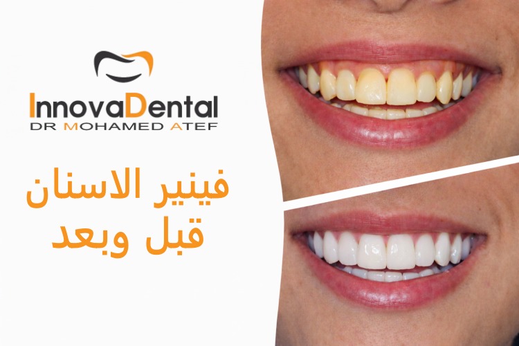 فينير الاسنان قبل وبعد: دليلك لابتسامة مثالية وثقة أكبر